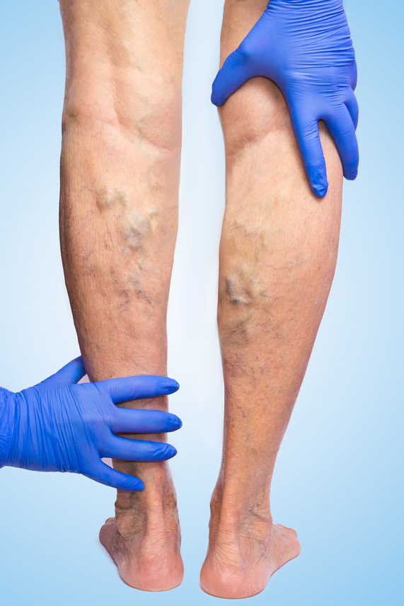 Venous Assessments & Treatment - JACE Private Clinic - Northern Ireland